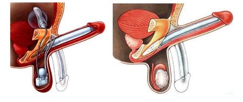 Prostesis penis dengan prostesis tiup (kiri) dan plastik (kanan)