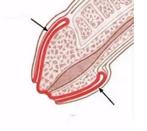 Peradangan penis
