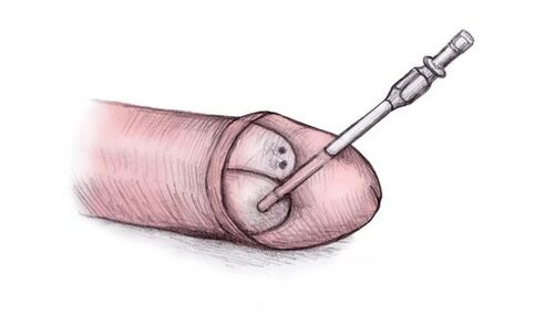 Kepala penis bisa diperbesar dengan menyuntikkan gel hialuronat ke dalamnya