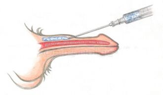 Pengisi injeksi asam hialuronat ke dalam penis